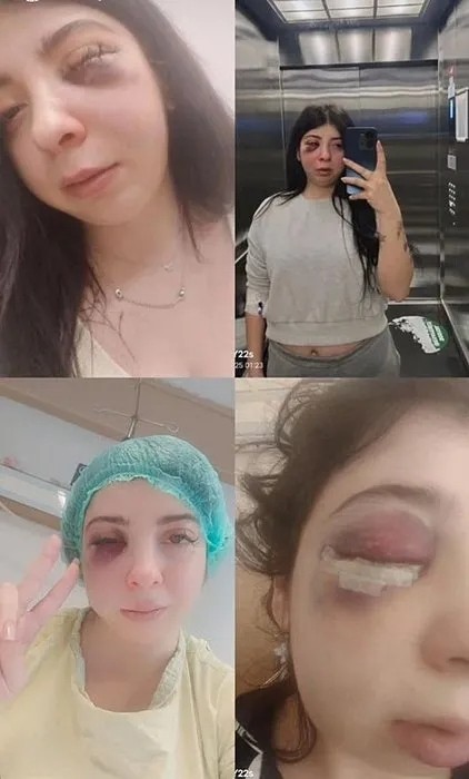 Samsun’da Damla Korkmaz sokak ortasında dehşeti yaşamıştı! “Yüzümde bir demirle sonsuza dek…”